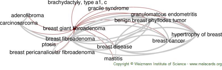 Breast Fibroadenomas: Symptoms, Diagnosis, Treatment