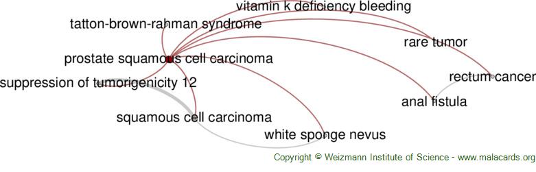 Prostate Squamous Cell Carcinoma Disease Malacards Research Articles Drugs Genes Clinical