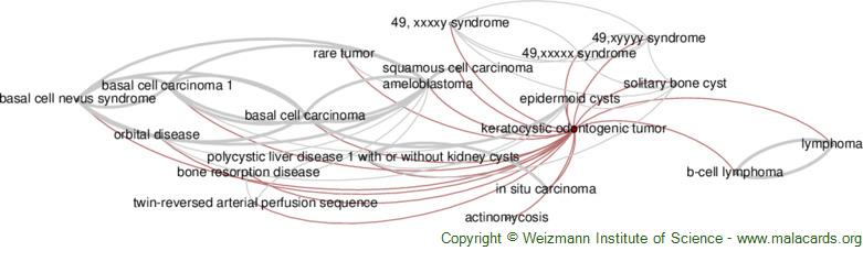 keratocystic odontogenic tumor